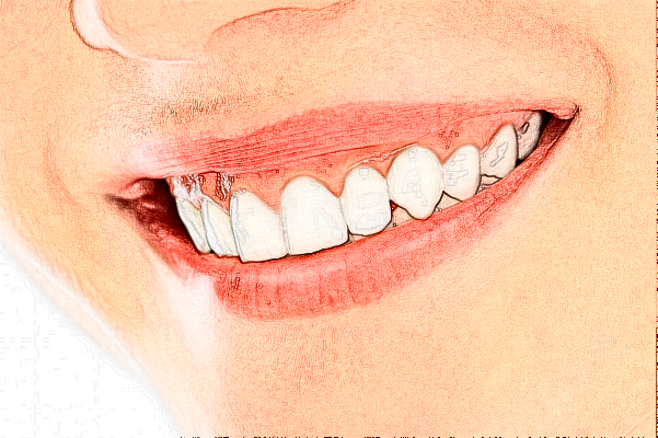 2024重慶醫(yī)科大學附屬口腔醫(yī)院牙齒美白需要多少錢_案例分享