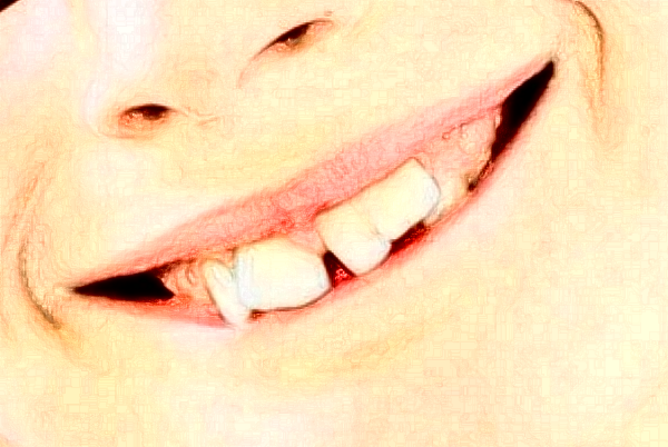 2024重慶醫(yī)科大學(xué)附屬口腔醫(yī)院做的全瓷冠怎么樣【全瓷冠案例】