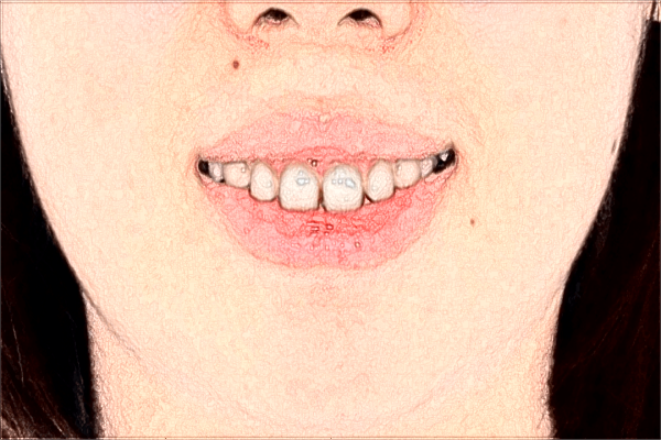 2024昆明市第一人民醫(yī)院種牙多少錢?種牙好還是鑲牙好