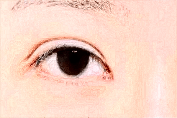 青島401醫(yī)院近視手術(shù)好不好?近視手術(shù)有哪些后遺癥