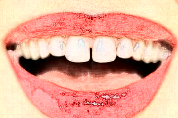 2024四川大學(xué)華西口腔醫(yī)院美白牙齒怎么樣_醫(yī)生技術(shù)好不好