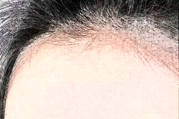 　　發(fā)際線不好看、大量脫發(fā)導(dǎo)致禿頂?shù)那闆r等，會給朋友們帶來很大的煩惱，這種情況可以選擇植發(fā)手術(shù)來，大連醫(yī)科大學(xué)附屬第一醫(yī)院做植發(fā)的技術(shù)比較不錯，根據(jù)大連地區(qū)網(wǎng)絡(luò)檢索的結(jié)果，比較常見的是發(fā)際線價(jià)格一般會在1100-38000元左右不等，比較常見的頭頂加密植發(fā)價(jià)格一般會在900-9300元左右不等，以上給出的價(jià)格僅供于參考，具體詳細(xì)的價(jià)格還需要到醫(yī)院找醫(yī)生進(jìn)行面診之后來獲取。  　　1、2024大連醫(yī)科大學(xué)附屬第一醫(yī)院植發(fā)案例  　　很多年前自己一直脫頭發(fā)，其實(shí)這也屬于正常的反應(yīng)，因?yàn)轭^發(fā)都會有一個新陳代謝，隨著時間的增加，自己的頭發(fā)脫的有點(diǎn)多，每一次洗頭發(fā)的時候都掉一大把，當(dāng)時也沒有太在意，一次無意間發(fā)現(xiàn)了自己頭頂?shù)念^發(fā)有一些稀少，這才意識到了脫發(fā)的嚴(yán)重性，所以想通過植發(fā)手術(shù)來，在家人的陪同下來到了大連醫(yī)科大學(xué)附屬第一醫(yī)院，跟醫(yī)生說明了自己掉發(fā)的情況，并且問了醫(yī)生能不能做植發(fā)手術(shù)，醫(yī)生采取診斷之后建議說可以做植發(fā)手術(shù)，所以配合了醫(yī)生的工作，整體手術(shù)操作大概用了不到三個小時左右的時間，術(shù)后就能夠看到一些植發(fā)的痕跡，在半個月之后直的頭發(fā)慢慢的長了出來，看到長出來的頭發(fā)自己的心情也愉悅了很多，終于不用擔(dān)心頭發(fā)稀少的問題帶來的困擾了。  　　2、2024大連醫(yī)科大學(xué)附屬第一醫(yī)院簡介  　　大連醫(yī)科大學(xué)附屬第一醫(yī)院整形美容科是一個集醫(yī)療、教學(xué)、科研、預(yù)防為一體的大型綜合性醫(yī)院，醫(yī)院包括有美容外科、整形外科、頜面美容外科、皮膚激光美容外科等，醫(yī)院開展的手術(shù)項(xiàng)目有先天性和創(chuàng)傷性的畸形修復(fù)、除皺、乳房整形、減肥、面部年輕化抗衰老、植發(fā)、手術(shù)、手術(shù)等多個項(xiàng)目，醫(yī)院多年的發(fā)展結(jié)合了先進(jìn)的技術(shù)和設(shè)備儀器，建立了一個重大特色的項(xiàng)目合作單位，并定期會派專業(yè)的醫(yī)護(hù)人員進(jìn)行整形美容技術(shù)學(xué)術(shù)交流和研討，為廣大女性朋友在求美的道路上制定個性化的醫(yī)美服務(wù)，醫(yī)院內(nèi)的醫(yī)生都有著先手的操作手法，組建了一支技術(shù)精湛的醫(yī)生團(tuán)隊(duì)，會為女性朋友在秋美的道路上所需求，進(jìn)行個性化的設(shè)計(jì)和診斷，得到了很多朋友們的一致好評。