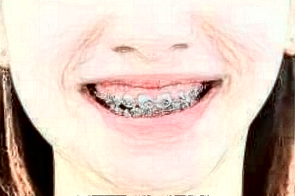 合肥市第二人民醫(yī)院牙齒矯正價(jià)格多少?牙齒矯正案例分享