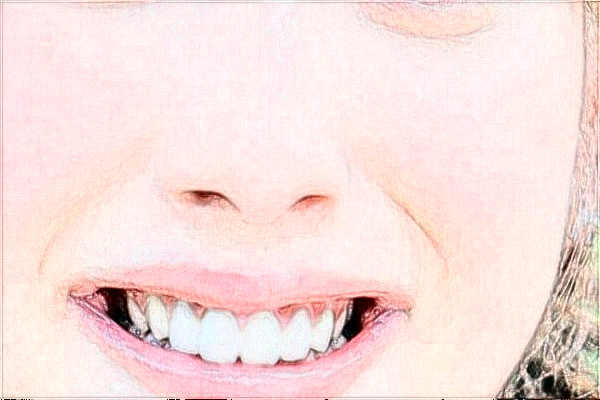 四川大學華西口腔醫(yī)院牙齒正畸好不好_哪個醫(yī)生做的不錯