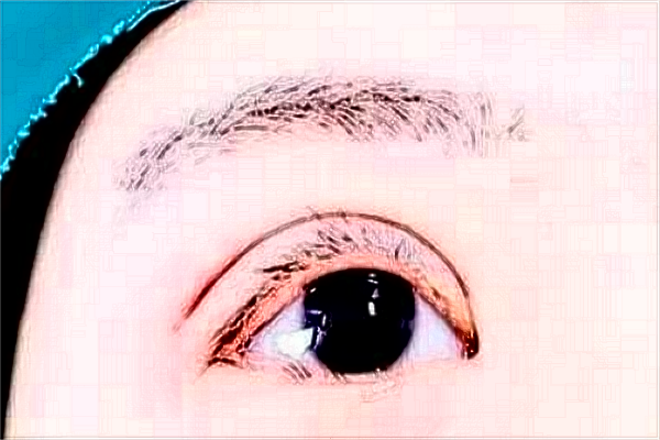 上海切開雙眼皮做的好不好_哪家醫(yī)院做的比較好