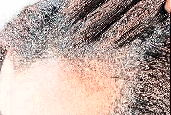 2024金華市中心醫(yī)院植發(fā)做的好嗎_案例+價(jià)格