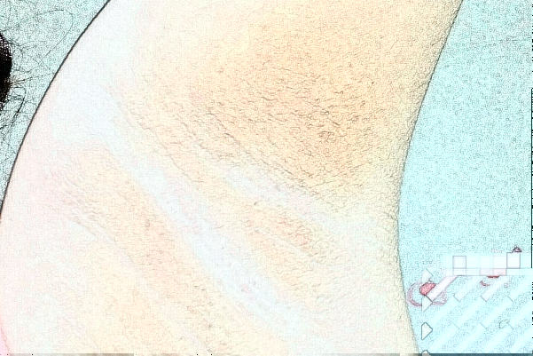 徐州市中心醫(yī)院去狐臭怎么樣_價格+案例分享