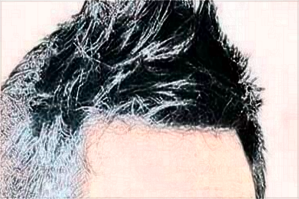 中山大學附屬第一醫(yī)院植發(fā)選哪個科?植發(fā)的危害和后遺癥