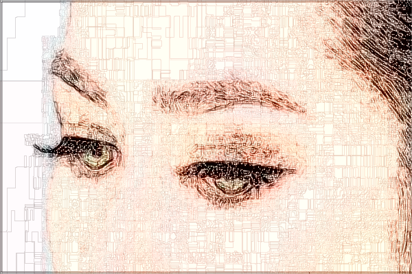 2024中山市人民醫(yī)院去眼袋多少錢(qián)?去眼袋手術(shù)恢復(fù)期多久