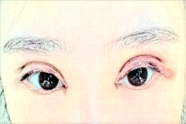 天津市第一中心醫(yī)院割雙眼皮做的好嗎_醫(yī)生推薦