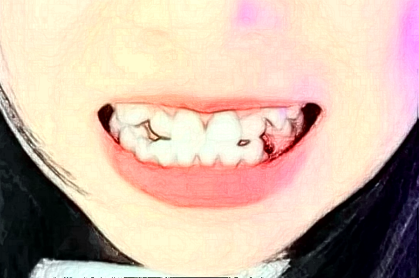 天津市口腔醫(yī)院美白牙齒做的好嗎_案例日記分享