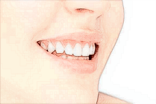 2024中山大學(xué)附屬口腔醫(yī)院做牙貼面價(jià)格?牙貼面的優(yōu)點(diǎn)和缺點(diǎn)