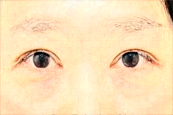 2024徐州市中心醫(yī)院激光消除黑眼圈做的好嗎?體驗案例分享