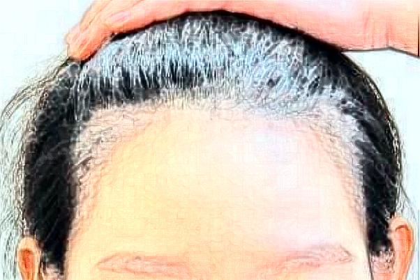 2024天津人民醫(yī)院植發(fā)價(jià)目表(價(jià)格表)_口碑怎么樣