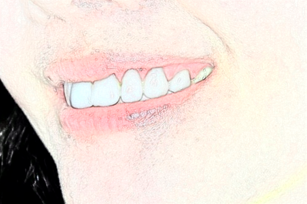 天津市口腔醫(yī)院半口種植做的好嗎？醫(yī)生排名