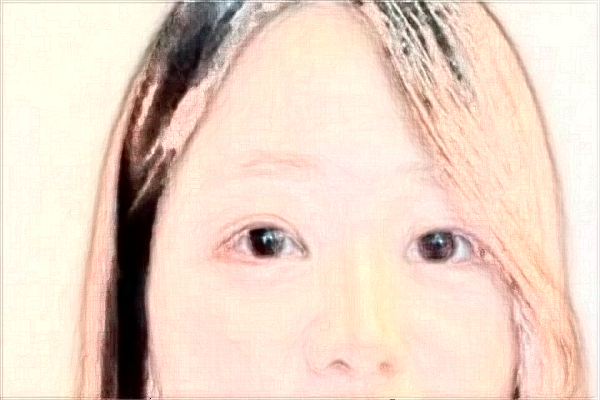 2024阜陽(yáng)市人民醫(yī)院去眼袋怎么樣_案例分享