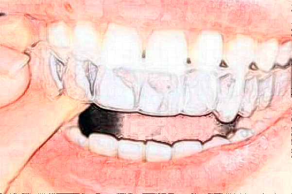 2024天津醫(yī)科大學(xué)口腔醫(yī)院全口牙矯正怎么樣_醫(yī)生排名_案例