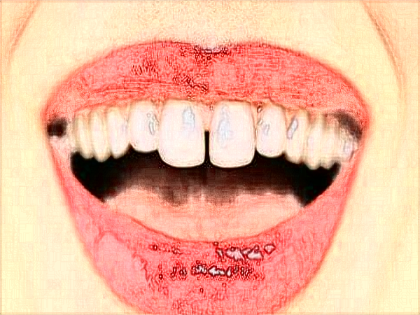 2024中山大學(xué)附屬口腔醫(yī)院洗牙收費標(biāo)準(zhǔn)?洗牙能讓牙變白?