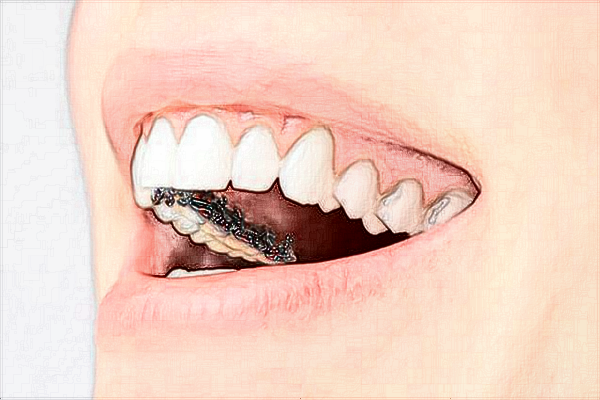 武漢大學口腔醫(yī)院種植牙哪個醫(yī)生好?種植牙技術好嗎