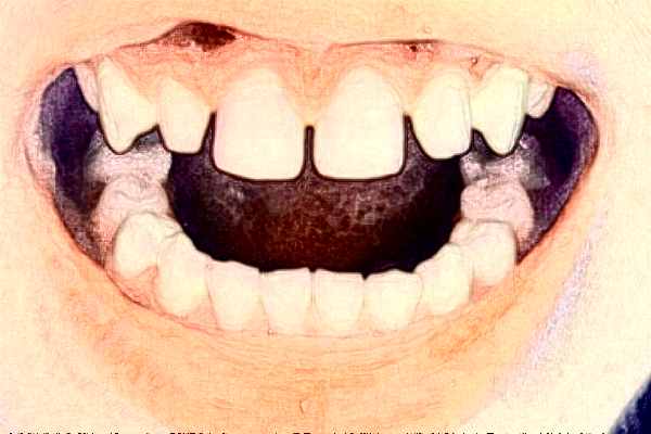 常州市第三人民醫(yī)院口腔科牙齒不齊矯正多少錢_真實案例分享