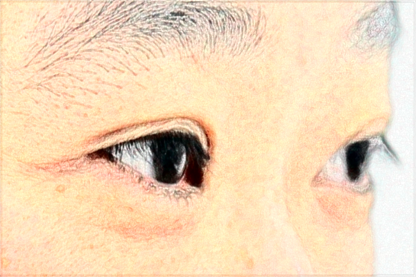 金華市中心醫(yī)院割雙眼皮做的好嗎_案例反饋