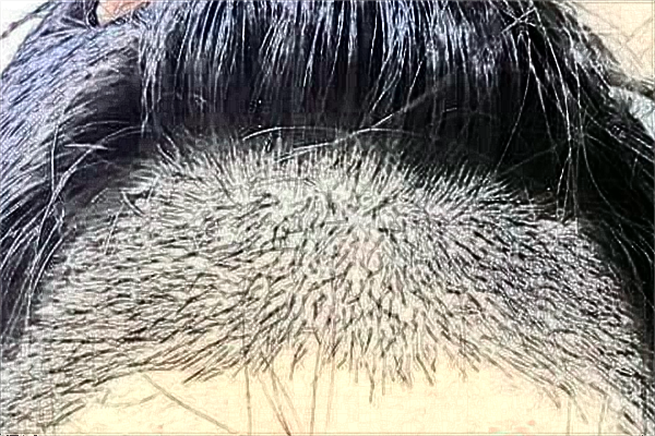 江蘇大學(xué)附屬醫(yī)院植發(fā)怎么樣_哪個(gè)醫(yī)生比較好