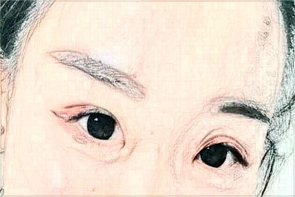 江蘇大學(xué)附屬醫(yī)院激光洗眼線怎么樣?實(shí)測案例分享