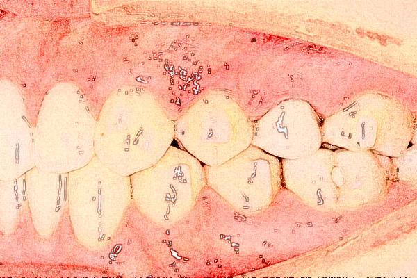 金華市中醫(yī)院洗牙怎么樣_洗牙后多久可以吃東西