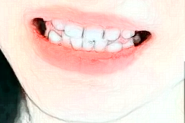 2024天津醫(yī)科大學(xué)第二醫(yī)院口腔科口腔修復(fù)價(jià)格嘗鮮版_體驗(yàn)日記分享