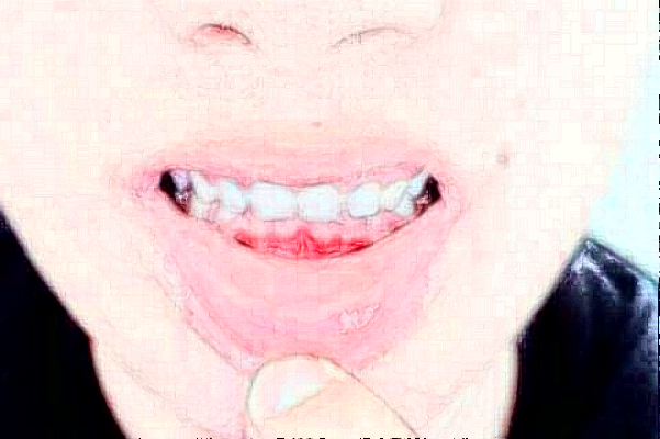 2024天津市第三中心醫(yī)院口腔科烤瓷牙做的怎么樣_哪位醫(yī)生技術(shù)比較好