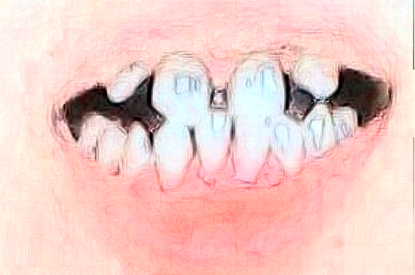 2024太原市中心醫(yī)院口腔科種植修復(fù)怎么樣?實測案例分享