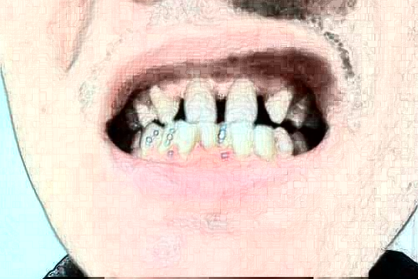 2024天津醫(yī)科大學(xué)第二醫(yī)院口腔科補(bǔ)牙大概多少錢?實測案例分享