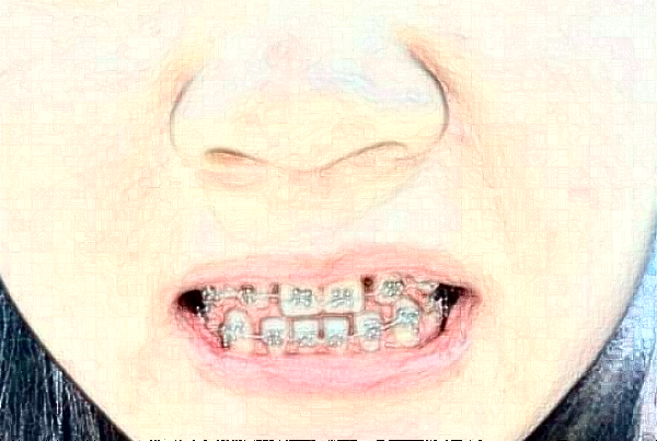 南京中大醫(yī)院口腔科牙頜畸形矯正做的怎么樣_誰(shuí)做的比較好