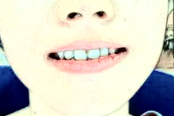 無錫市第一人民醫(yī)院口腔科種植牙修復(fù)怎么樣_整形日記分享