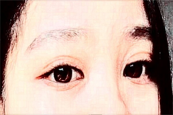 2024安徽省立醫(yī)院全飛秒激光多少錢？誰做得好