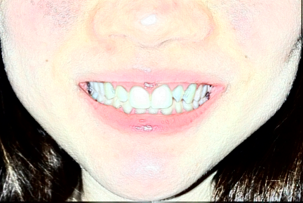 2024吉林大學(xué)第一醫(yī)院口腔科牙齒矯正做的好嗎?誰做得好