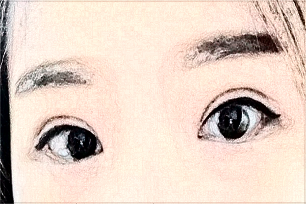 2024山西醫(yī)科大學(xué)第一醫(yī)院半飛秒怎么樣_整形日記分享