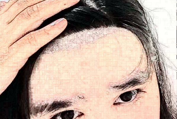 太原市中心醫(yī)院植發(fā)怎么樣_哪個(gè)醫(yī)生比較好