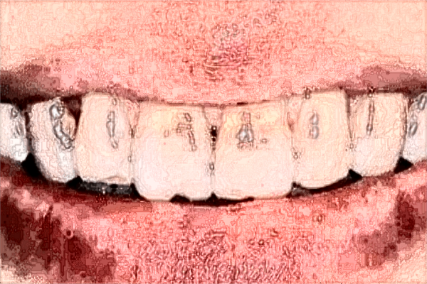 2024中山大學(xué)附屬第三醫(yī)院鑲牙多少錢(qián)?鑲牙過(guò)程疼不疼