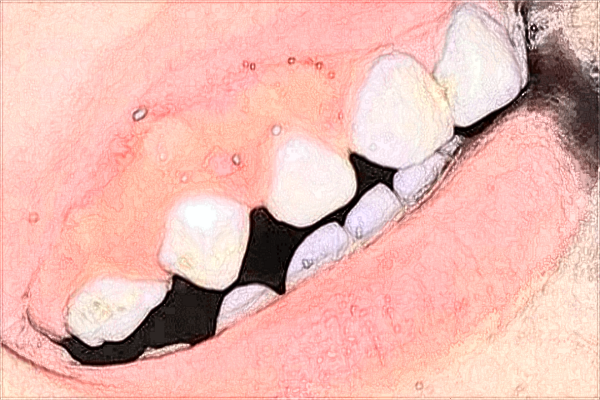 中山大學附屬第三醫(yī)院補牙怎么樣?補牙需要注意哪些