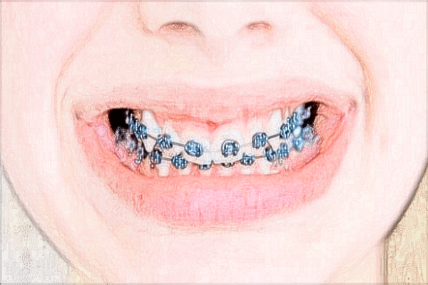 2024山東省千佛山醫(yī)院正畸科價(jià)格?正畸科的范圍包括什么