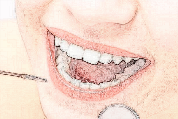 2024中山大學(xué)附屬口腔醫(yī)院種植牙齒多少錢?種植牙齒利弊