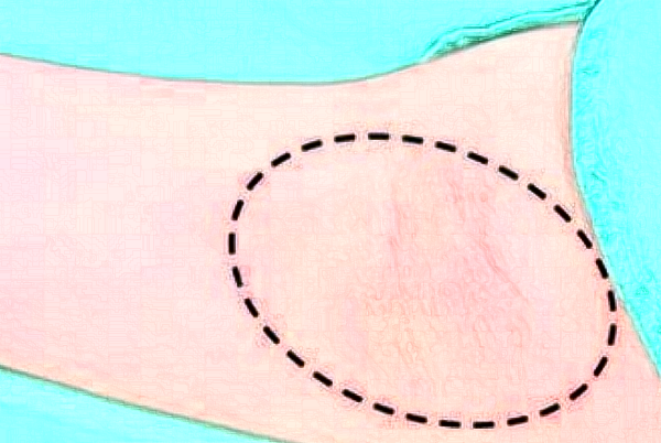 2024無錫市第一人民醫(yī)院去狐臭怎么樣_整形日記分享