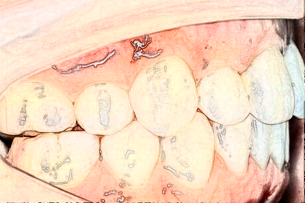 南通大學(xué)附屬醫(yī)院隱形正畸做的好嗎？誰做的好