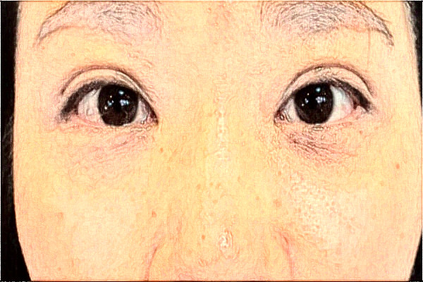 2024天津市醫(yī)科大學眼科醫(yī)院全飛秒做的好嗎?誰做得好