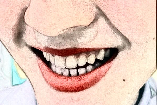 2024丹東市第一醫(yī)院種植牙修復價格多少_真實案例分享