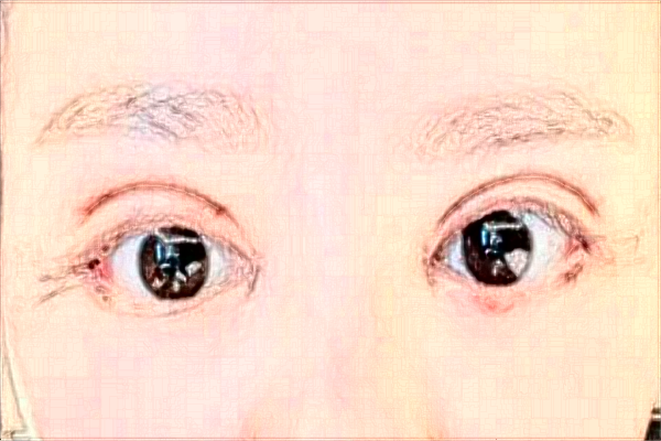 天津醫(yī)科大學總醫(yī)院割雙眼皮做的怎么樣_哪位醫(yī)生技術比較好