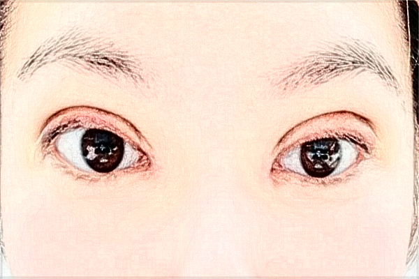 天津醫(yī)科大學總醫(yī)院割雙眼皮做的怎么樣_哪位醫(yī)生技術比較好