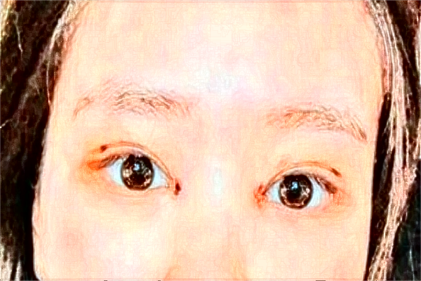 揚州市第一人民醫(yī)院全飛秒價格多少?做的怎么樣