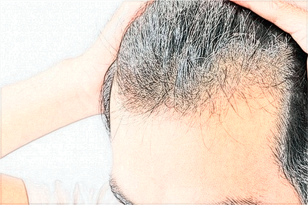 2024青島市立醫(yī)院植發(fā)費用?植發(fā)需要把頭發(fā)剃光嗎